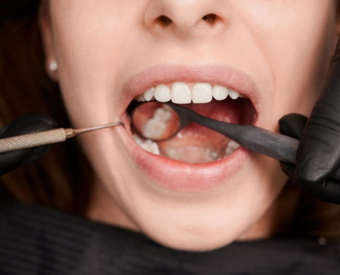 revisión desmineralización dental