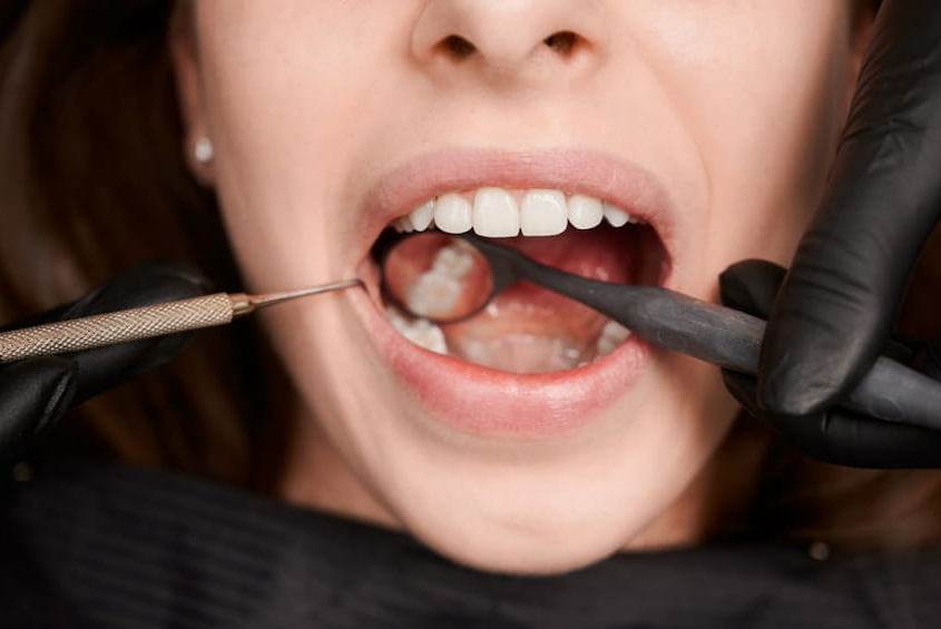 revisión desmineralización dental