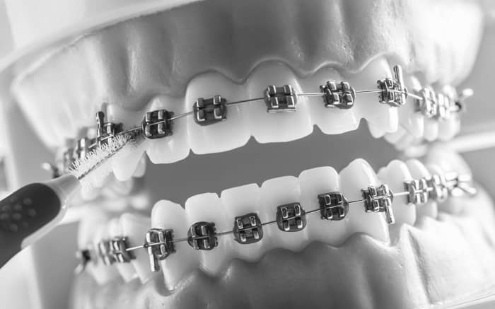 limpieza de brackets - ortodoncia
