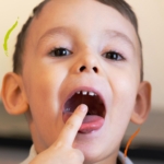 niño señalando sus dientes con sindrome de cara larga