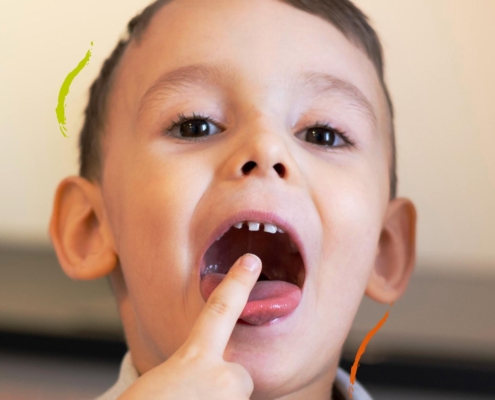 niño señalando sus dientes con sindrome de cara larga