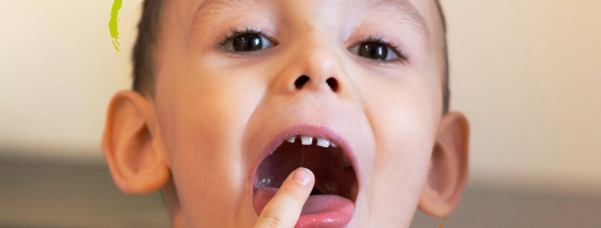 niño señalando sus dientes con sindrome de cara larga