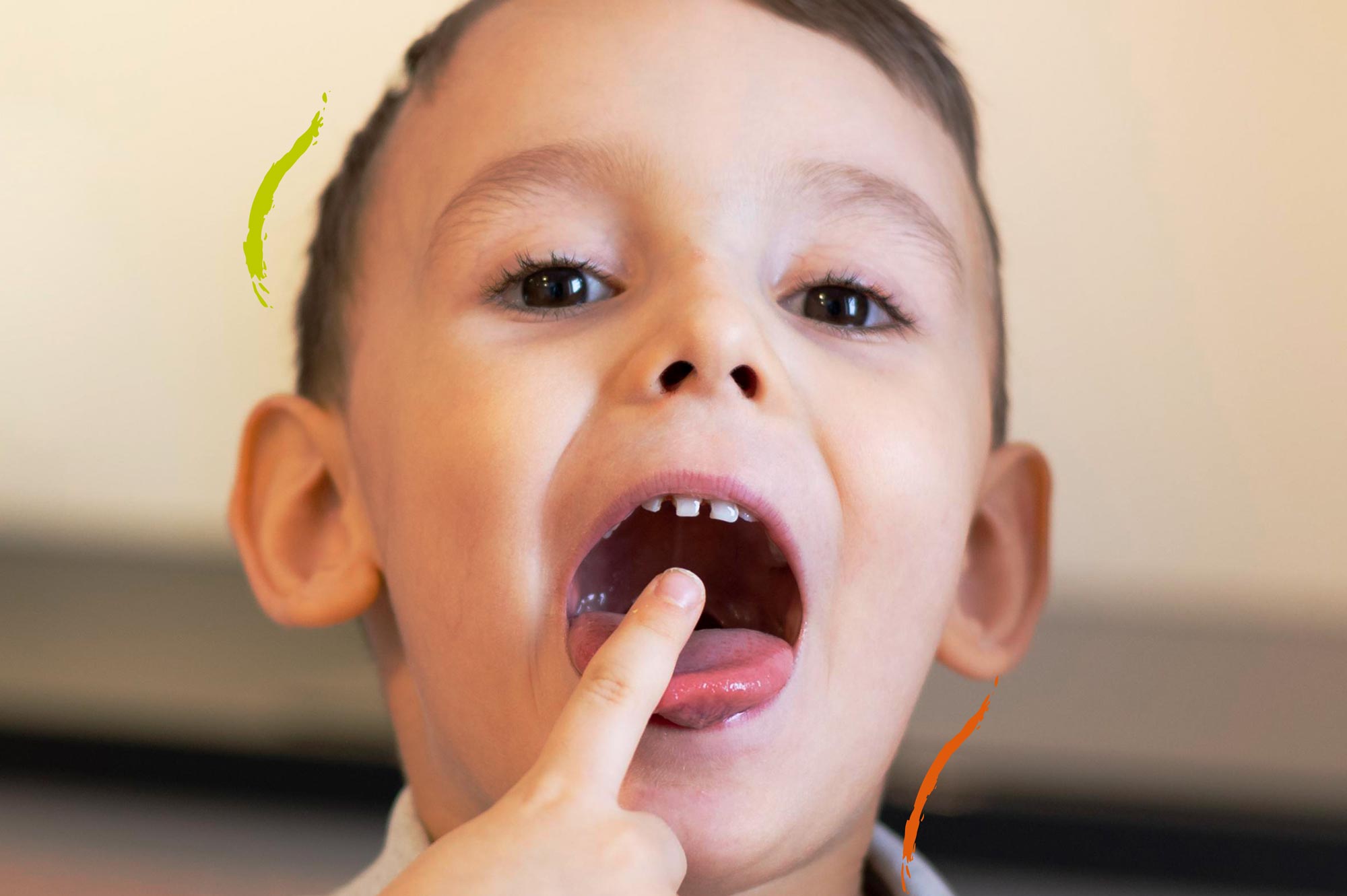 niño señalando sus dientes con sindrome de cara larga