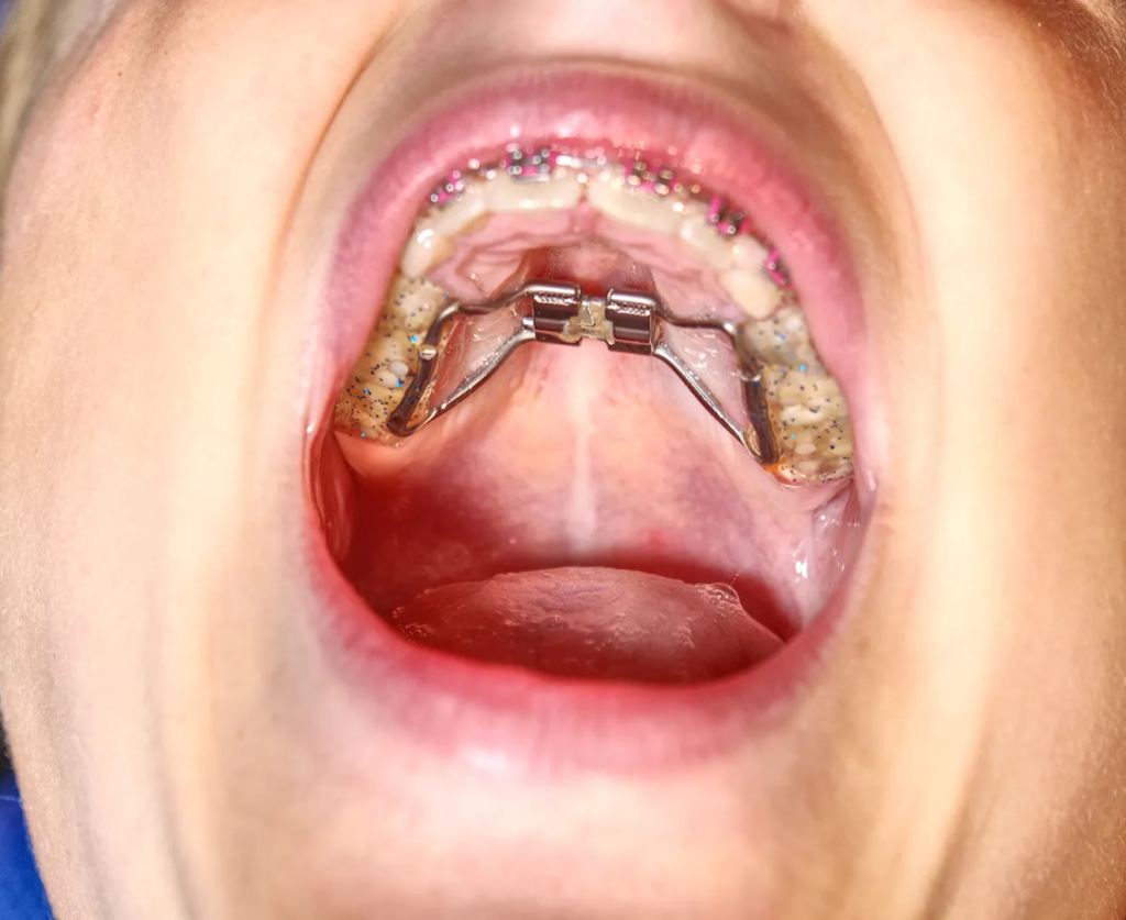 imagen del paladar de un niño con un aparato dental expansor