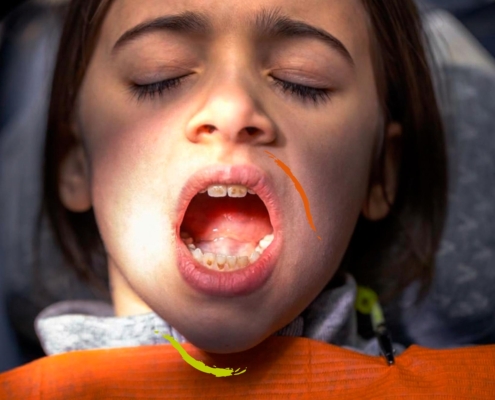 Niño con manchas en los dientes tras tomar antibióticos