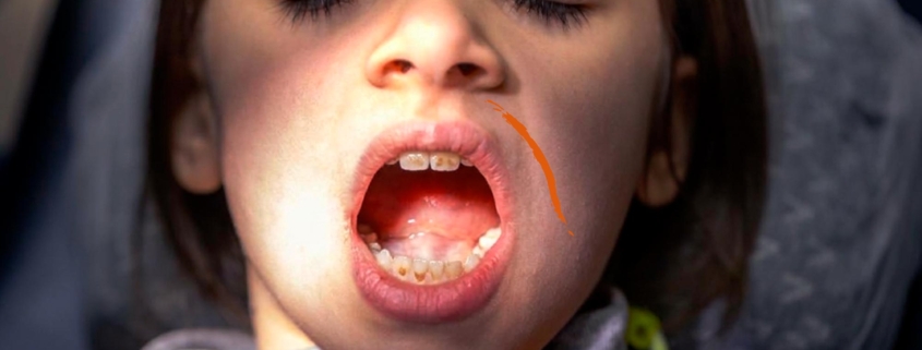 Niño con manchas en los dientes tras tomar antibióticos