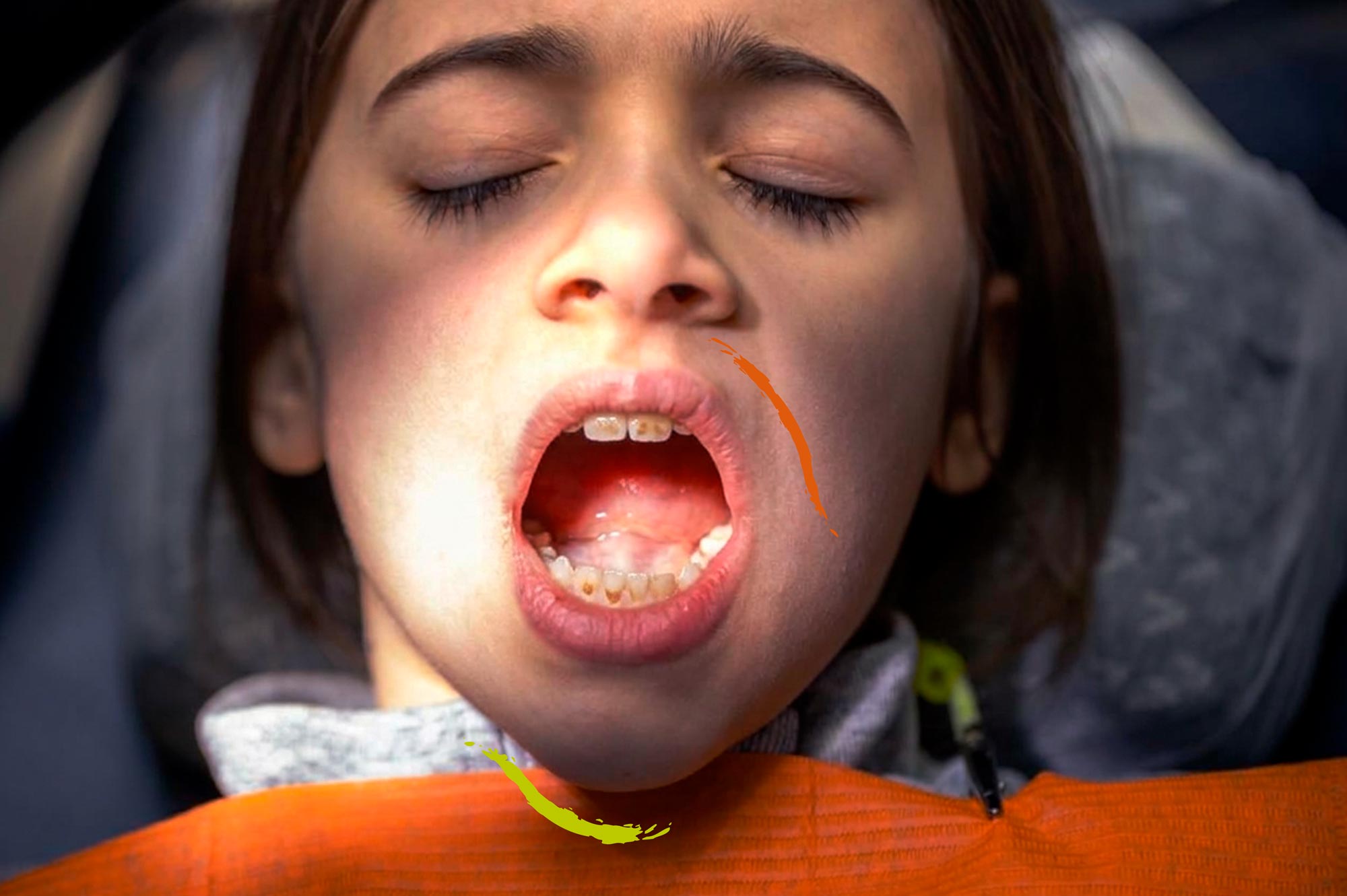 Niño con manchas en los dientes tras tomar antibióticos